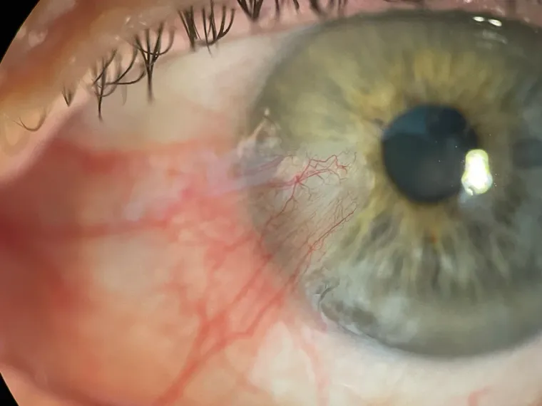 Clinical photograph of a pterygium
