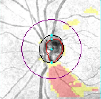 OCT retinal nerve fibre layer scan showing a glaucomatous defect