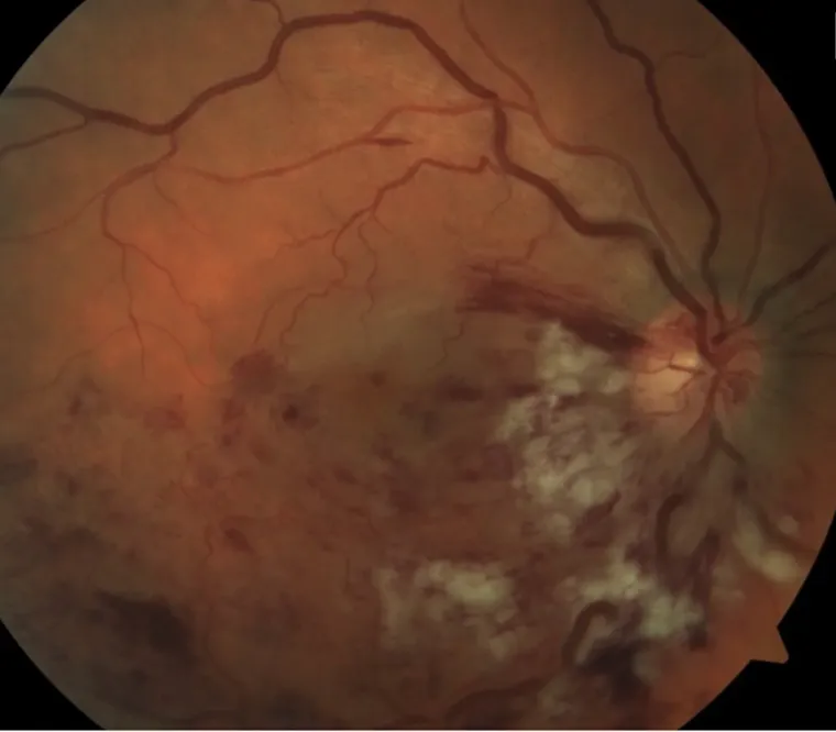 Fundus photograph of a branch retinal vein occlusion with haemorrhages and cotton-wool spots