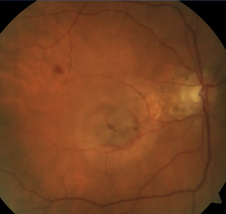 Retinal photograph of wet macular degeneration affecting the macula